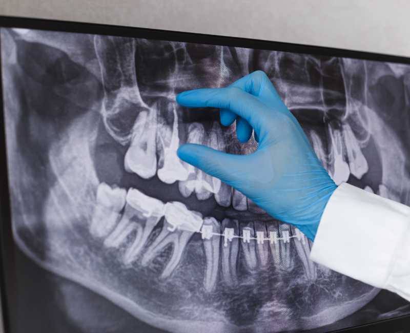 Panoramic Dental Xrays What You Need to Know SK Radiology